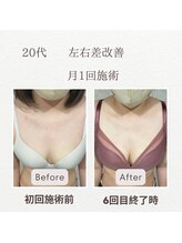 東広島西条整骨院/20代　バストアップ実績