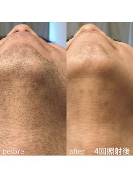 クレヴィー(Creviy)/ヒゲ脱毛（4回照射の男性）