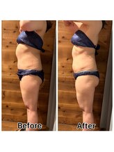 サラモ(Sa La Mo)/脂肪冷却　