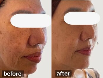 ココモンド(COCOMONDO)/幹細胞フェイシャル/エイジング