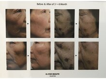 ピュール(pure)/純粋レチノールピールの効果