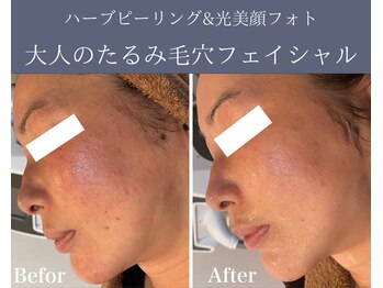 エノアビューティー(ENOA beauty)/ハーブピーリング+美顔フォト