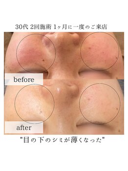 リノ(Lino)/シミケア2回の変化