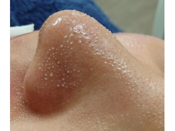 エステティックサロンアネラ(Anela)/皮脂を柔らかくする美容液を塗布