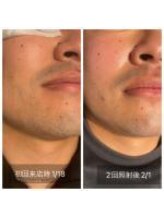 ブリッシュ(Bullish)/ヒゲ脱毛2回目照射後の途中経過