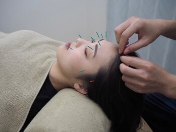 七つ葉鍼灸接骨院の写真/本格美容鍼★ご新規様<自律神経美容鍼＋調整鍼60分8000円！>小顔・リフトアップ・肌質改善・腰痛緩和等♪