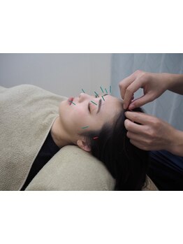 鍼灸施術を受けたい