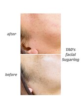 ヒロット タオ(HILOT TAO)/Sugaring 顔脱毛