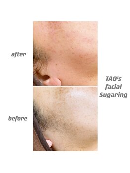 ヒロット タオ(HILOT TAO)/Sugaring 顔脱毛