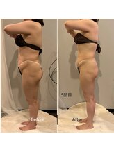 ソウソウビューティー 五反田(Shou Shou Beauty)/施術5回/ハイパーナイフEX