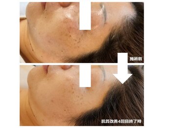 リセル(RE.cell)/肌質改善4回後