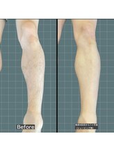 アレッド 大阪店(ared.)/人気の足脱毛