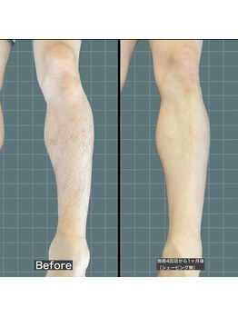 アレッド 大阪店(ared.)/人気の足脱毛