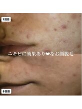 ミラーヴ(MERAVE)/脱毛でニキビケアも♪