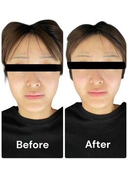 ブライトプラス(BRIGHT+)/大口式小顔整体ビフォーアフター