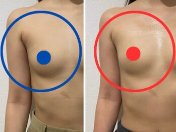 ポインセチア(Poinsettia)/施術回数2回の効果/並び比較