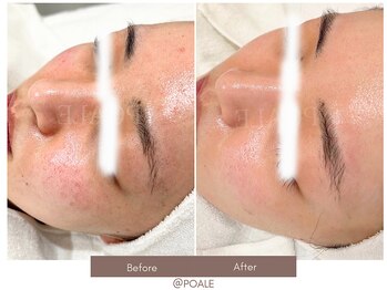 ポアレ 高崎店(POALE)/毛穴ケア症例【群馬/高崎】