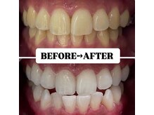 ホワイトニングサロン 豊中/Before&After美白ホワイトニング