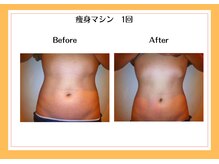 リヴェーヌ 富山店/部分集中で施術