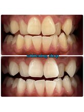 ホワイトニングショップ 三田店/before after