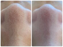 ヒスイ バイ アメイジング(Hisui by AMAZING)/【毛穴ケア】韓国式3D毛穴洗浄