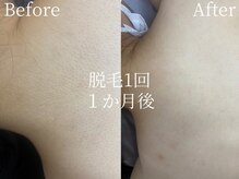 ミスティア(mistia)/脱毛 1回　１か月後