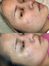 フルール ニコ(Fleur Nico)/2回のBeforeAfter