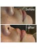 ≪フェイシャルWAX＋高濃度炭酸クレイパック≫★2回目以降も同じ価格でOK★