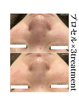 ヒルナム(Heal Nam)/プロセルセラピーズ~フェイス~