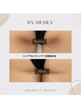 モア(more.)/おしり下黒ずみくすみ（1回）