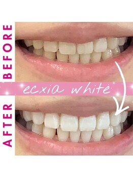 エクシアホワイト 新宿御苑店(ecxia white)/ホワイトニングビフォーアフター