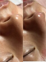 スパークル/毛穴/毛穴洗浄/フェイシャル