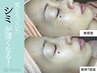 《シミケア20分し放題》５名限定／初回¥13,000→¥8,800