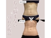 ソワン(Soin)/電磁パルス　お腹