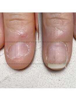 スマイルニコ(smile nico)/ピンクの部分が伸びました！