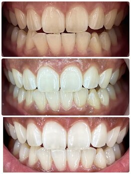 ホワイトニングサロンブライト 尼崎店(Whitening salon bright)/ホワイトニングをするなら!!!
