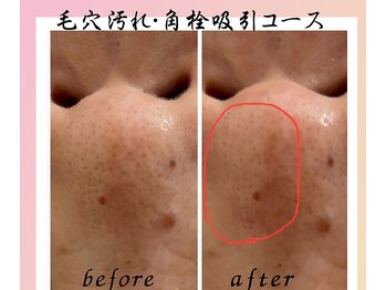 アイリーボーテ 東大阪(アイリーBEAUTE)/毛穴の黒ずみ・角栓吸引