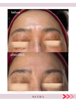 ミトラ(MITRA)/水光リフトプレミアムfacial2回