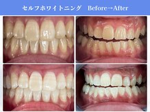 エクシアホワイトニング 岡崎店/岡崎エリア★口コミ・来店数No.1