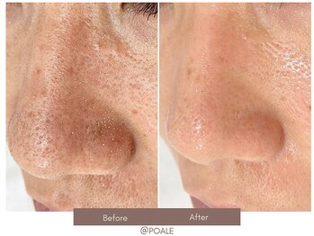 ポアレ 高崎店(POALE)/毛穴ケア症例【群馬/高崎】
