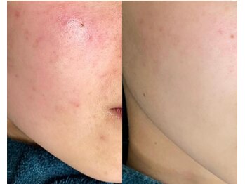 エヌ(N)/ハーブピーリングでの変化