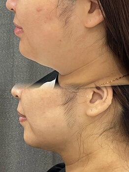 アエ メゾン(ae maison)/きゅっと引き締まった顎下に♪