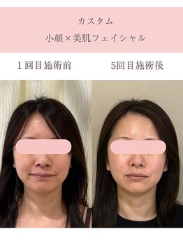 シンナリ(Shinnari)/カスタム小顔×美肌フェイシャル