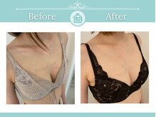 美人バスト 新潟店/ 【バストアップ★育乳】症例