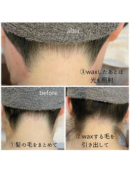 サロン ド モモ(salon de momo)/うなじ脱毛
