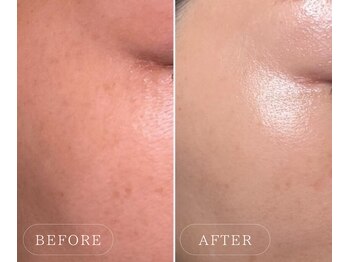 ルソール 銀座(Le seul)/高含有エクソソーム導入で水光肌