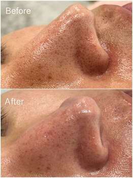 ジョアアンジェ 京橋店(joie ange)/毛穴ケア