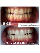 ホワイトニングサロン 京都烏丸店/ホワイトニング　施術例