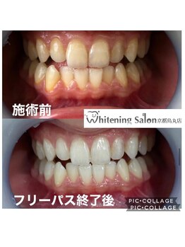 ホワイトニングサロン 京都烏丸店/ホワイトニング　施術例