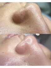 【毛穴洗浄＋開き毛穴引き締めコース】５回後・拡大してご覧ください